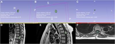 Association of quantitative radiomic shape features with functional outcome after surgery for primary sporadic dorsal spinal meningiomas
